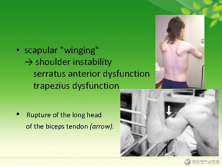  • scapular "winging" → shoulder instability serratus anterior dysfunction trapezius dysfunction • Rupture