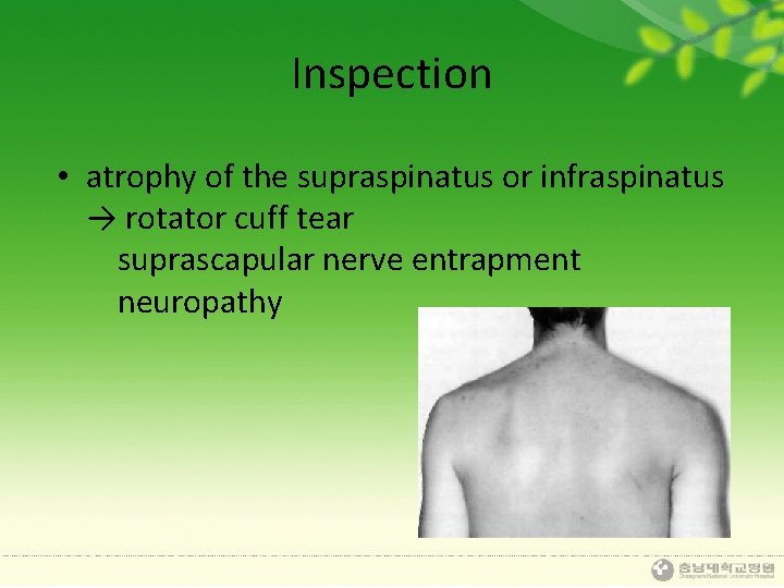 Inspection • atrophy of the supraspinatus or infraspinatus → rotator cuff tear suprascapular nerve