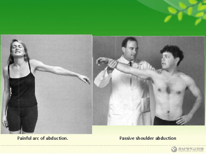 Painful arc of abduction. Passive shoulder abduction 