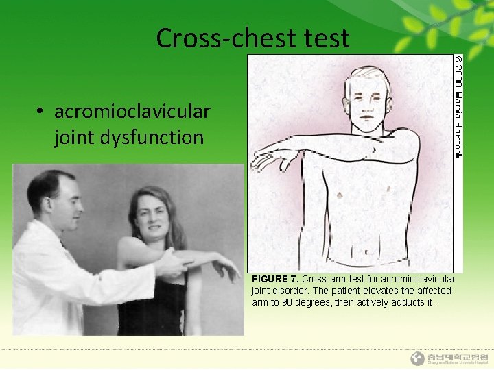 Cross-chest test • acromioclavicular joint dysfunction FIGURE 7. Cross-arm test for acromioclavicular joint disorder.