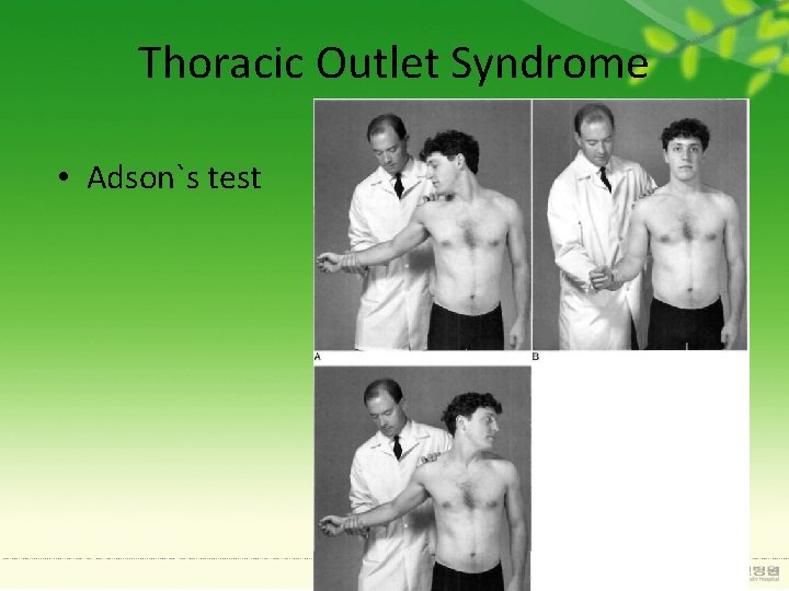 Thoracic Outlet Syndrome • Adson`s test 