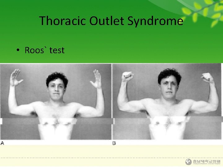 Thoracic Outlet Syndrome • Roos` test 