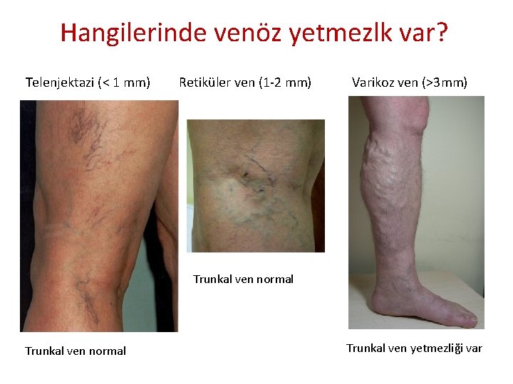 Hangilerinde venöz yetmezlk var? Telenjektazi (< 1 mm) Retiküler ven (1 -2 mm) Varikoz Hangilerinde venöz yetmezlk var? Telenjektazi (< 1 mm) Retiküler ven (1 -2 mm) Varikoz