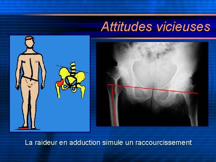 Attitudes vicieuses La raideur en adduction simule un raccourcissement 