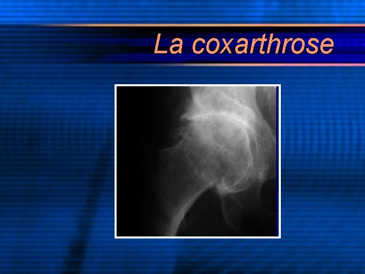 La coxarthrose 