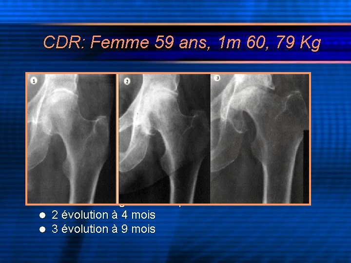 CDR: Femme 59 ans, 1 m 60, 79 Kg l l l 1 douleurs