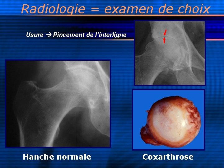 Radiologie = examen de choix Usure Pincement de l’interligne Hanche normale Coxarthrose 