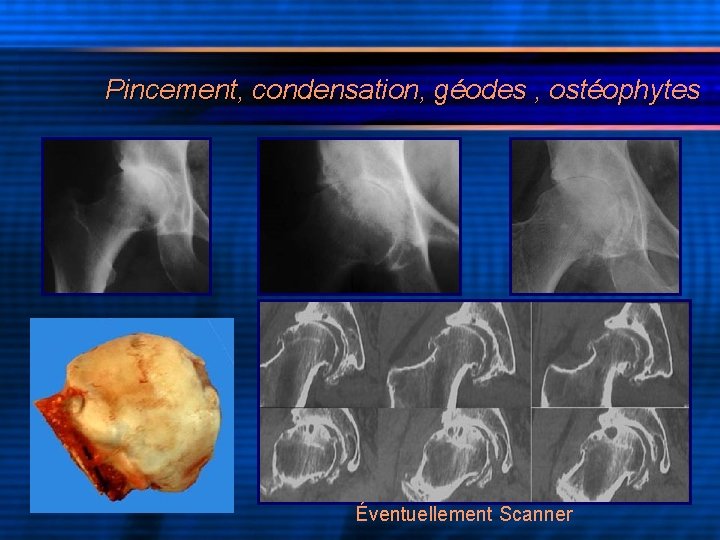 Pincement, condensation, géodes , ostéophytes Éventuellement Scanner 