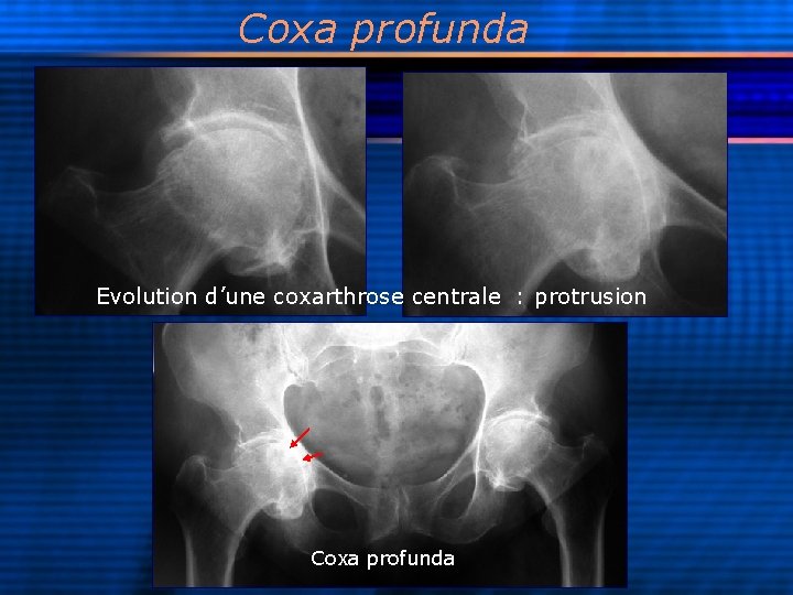 Coxa profunda Evolution d’une coxarthrose centrale : protrusion Coxa profunda 