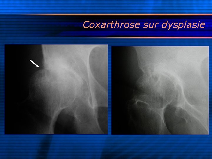 Coxarthrose sur dysplasie 