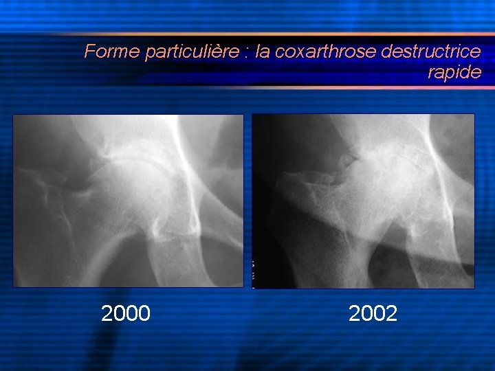 Forme particulière : la coxarthrose destructrice rapide 2000 2002 