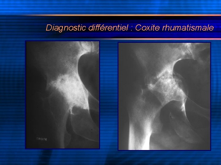 Diagnostic différentiel : Coxite rhumatismale 