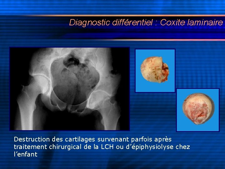 Diagnostic différentiel : Coxite laminaire Destruction des cartilages survenant parfois après traitement chirurgical de