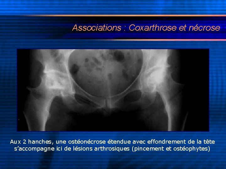 Associations : Coxarthrose et nécrose Aux 2 hanches, une ostéonécrose étendue avec effondrement de