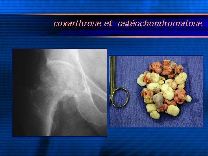 coxarthrose et ostéochondromatose 