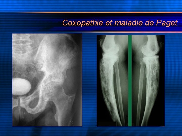 Coxopathie et maladie de Paget 