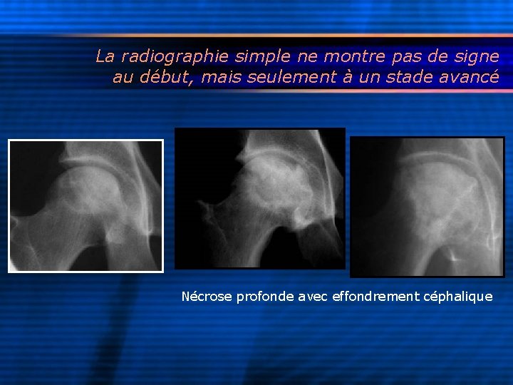 La radiographie simple ne montre pas de signe au début, mais seulement à un