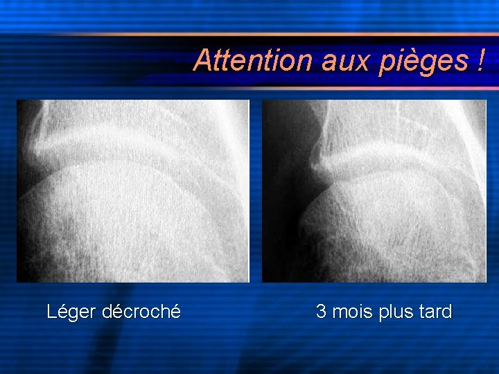 Attention aux pièges ! Léger décroché 3 mois plus tard 