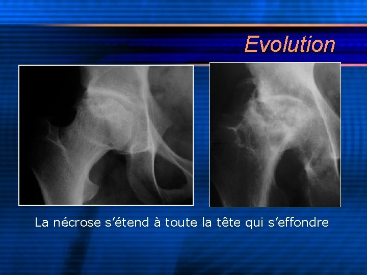 Evolution La nécrose s’étend à toute la tête qui s’effondre 