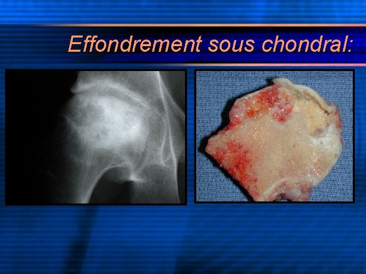 Effondrement sous chondral: 