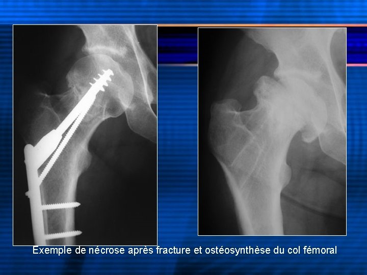 Exemple de nécrose après fracture et ostéosynthèse du col fémoral 