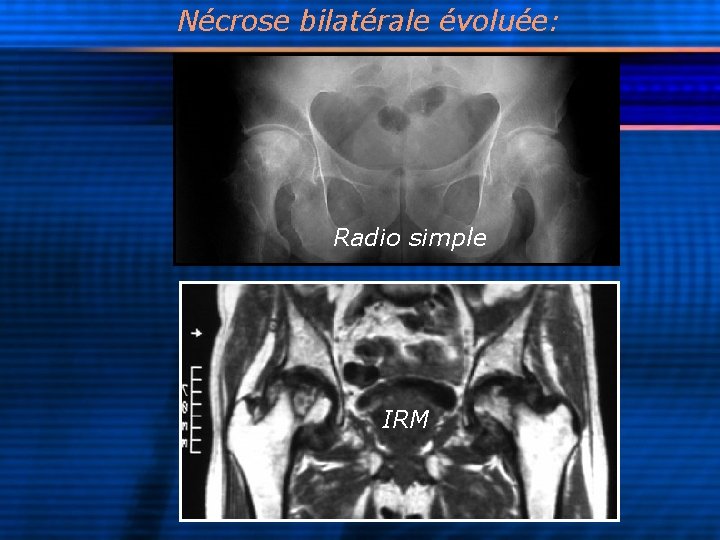 Nécrose bilatérale évoluée: Radio simple IRM 