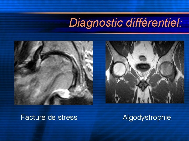 Diagnostic différentiel: Facture de stress Algodystrophie 