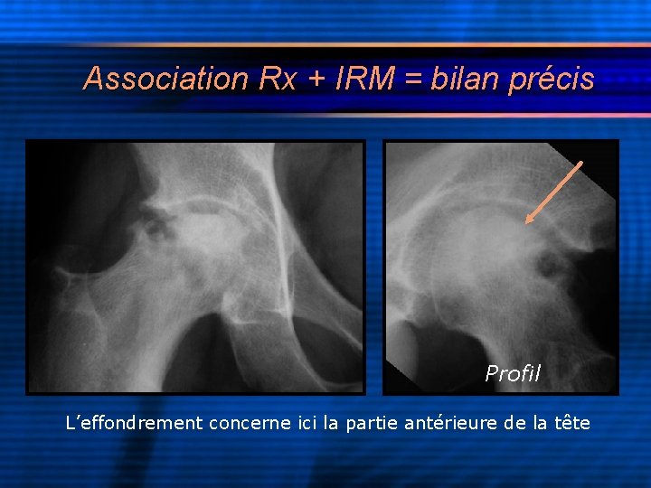 Association Rx + IRM = bilan précis Profil L’effondrement concerne ici la partie antérieure