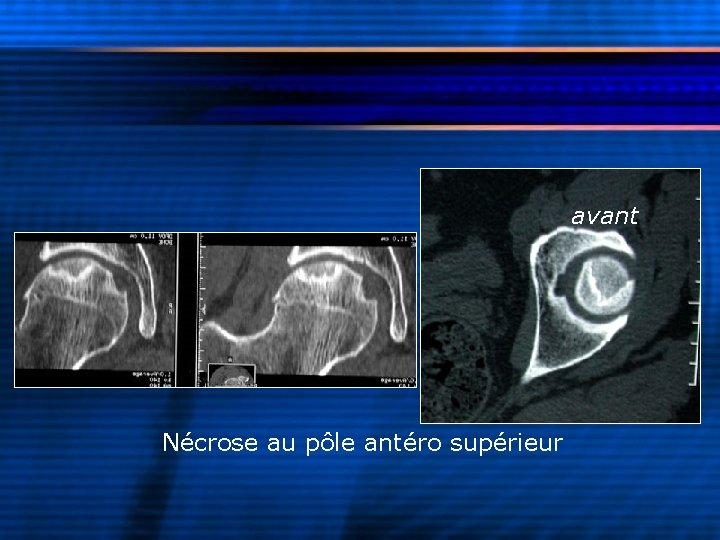 avant Nécrose au pôle antéro supérieur 