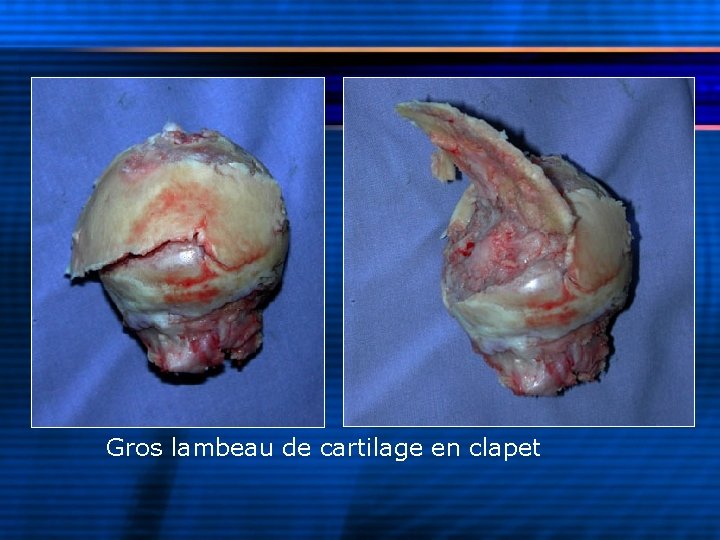 Gros lambeau de cartilage en clapet 