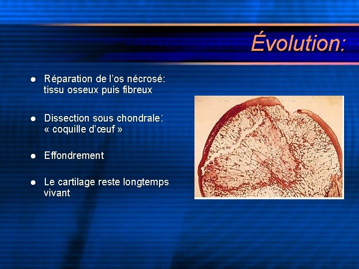 Évolution: l Réparation de l’os nécrosé: tissu osseux puis fibreux l Dissection sous chondrale:
