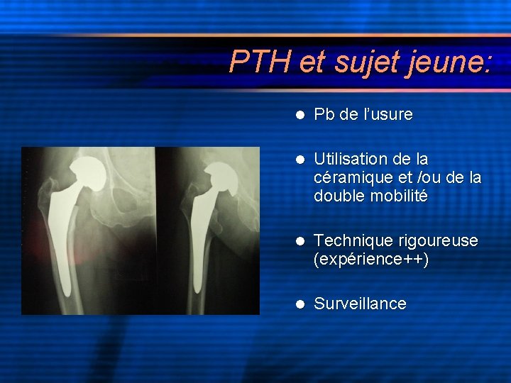 PTH et sujet jeune: l Pb de l’usure l Utilisation de la céramique et