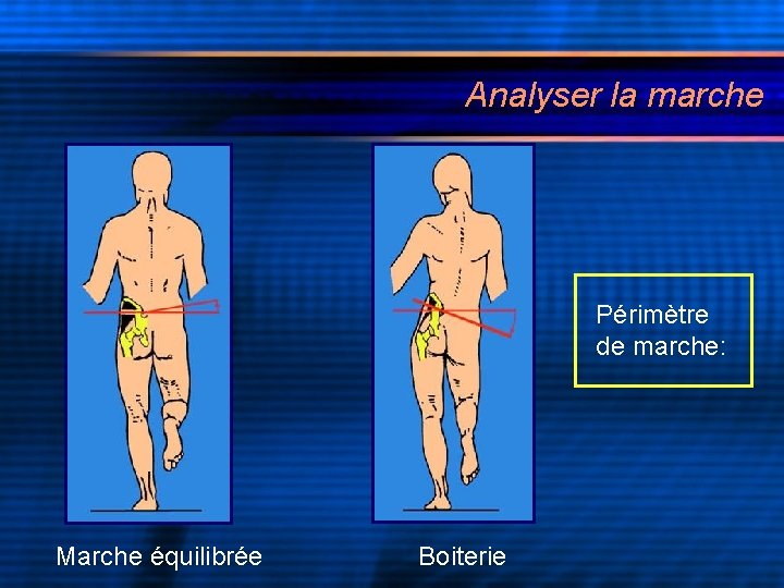 Analyser la marche Périmètre de marche: Marche équilibrée Boiterie 