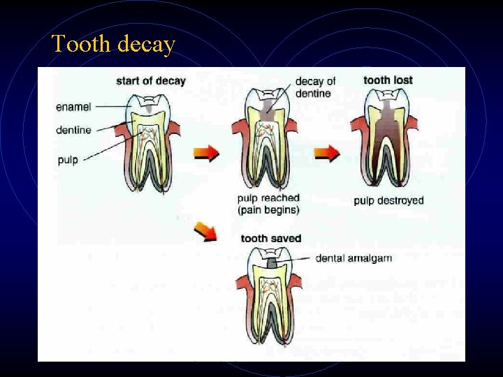 Tooth decay Tooth decay