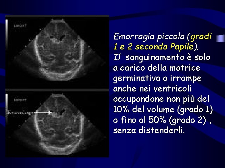 Emorragia piccola (gradi 1 e 2 secondo Papile). Il sanguinamento è solo a carico Emorragia piccola (gradi 1 e 2 secondo Papile). Il sanguinamento è solo a carico
