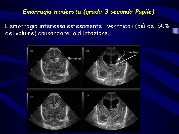 Emorragia moderata (grado 3 secondo Papile). L’emorragia interessa estesamente i ventricoli (più del 50% Emorragia moderata (grado 3 secondo Papile). L’emorragia interessa estesamente i ventricoli (più del 50%