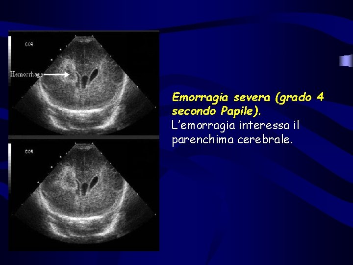 Emorragia severa (grado 4 secondo Papile). L’emorragia interessa il parenchima cerebrale. Emorragia severa (grado 4 secondo Papile). L’emorragia interessa il parenchima cerebrale.