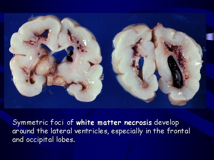 Symmetric foci of white matter necrosis develop around the lateral ventricles, especially in the Symmetric foci of white matter necrosis develop around the lateral ventricles, especially in the