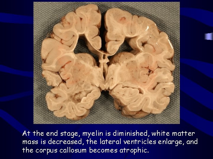 At the end stage, myelin is diminished, white matter mass is decreased, the lateral At the end stage, myelin is diminished, white matter mass is decreased, the lateral