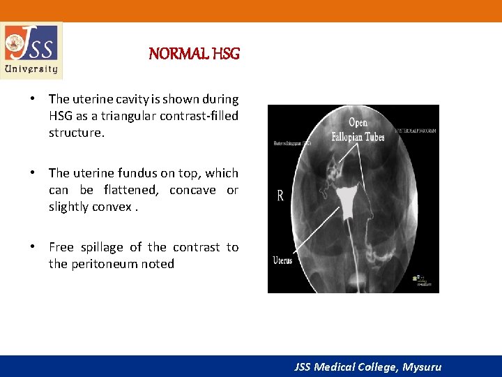 NORMAL HSG • The uterine cavity is shown during HSG as a triangular contrast-filled