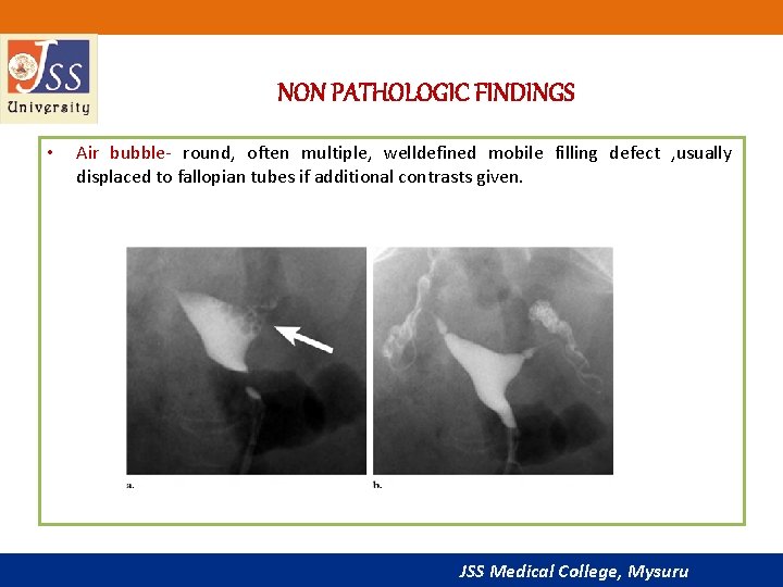 NON PATHOLOGIC FINDINGS • Air bubble- round, often multiple, welldefined mobile filling defect ,