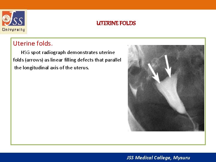 UTERINE FOLDS Uterine folds. HSG spot radiograph demonstrates uterine folds (arrows) as linear filling