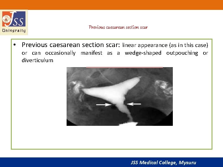 Previous caesarean section scar • Previous caesarean section scar: linear appearance (as in this