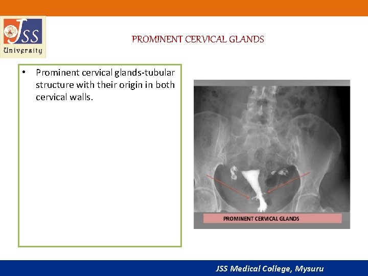 PROMINENT CERVICAL GLANDS • Prominent cervical glands-tubular structure with their origin in both cervical
