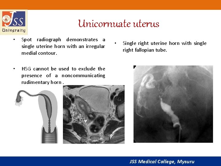 Unicornuate uterus • Spot radiograph demonstrates a single uterine horn with an irregular medial