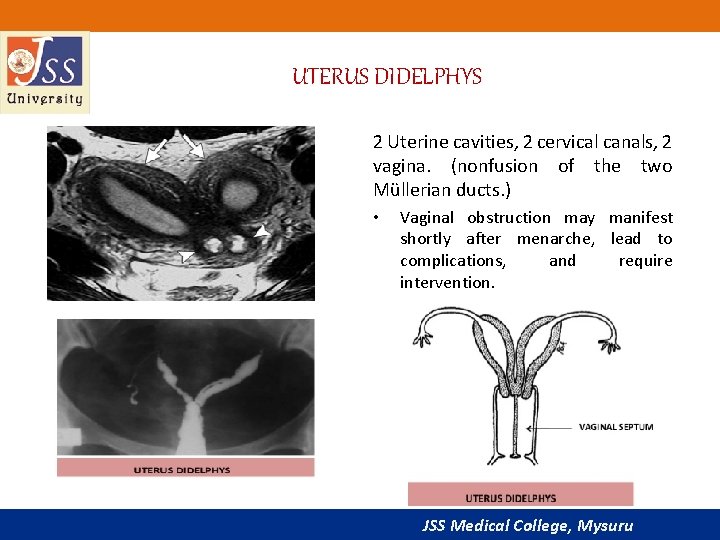 UTERUS DIDELPHYS 2 Uterine cavities, 2 cervical canals, 2 vagina. (nonfusion of the two