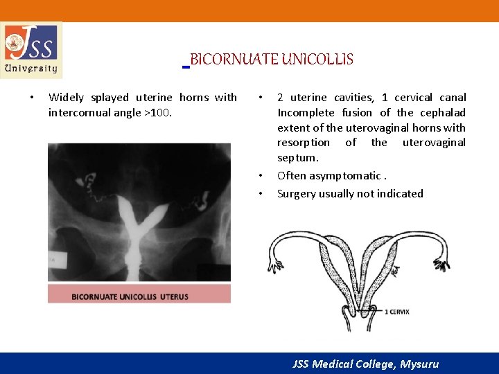  BICORNUATE UNICOLLIS • Widely splayed uterine horns with intercornual angle >100. • •