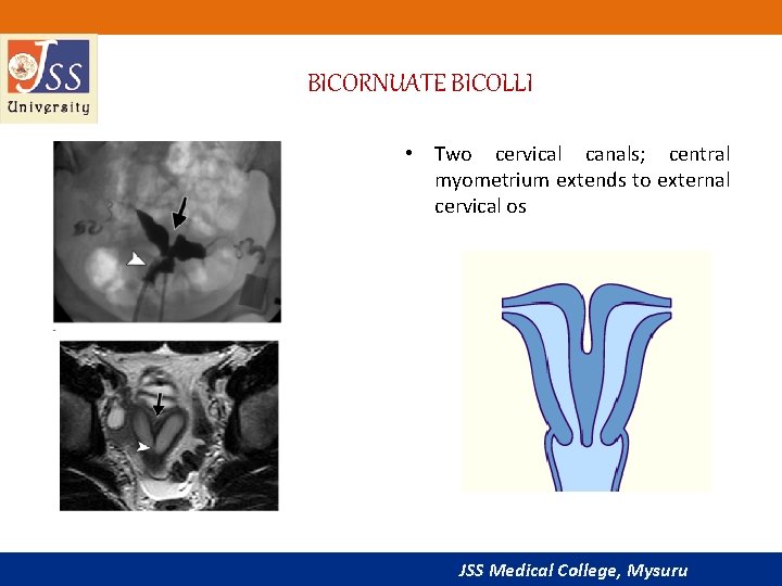 BICORNUATE BICOLLI • Two cervical canals; central myometrium extends to external cervical os JSS