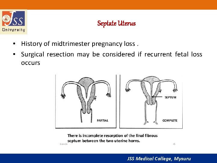 Septate Uterus • History of midtrimester pregnancy loss. • Surgical resection may be considered