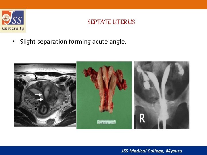 SEPTATE UTERUS • Slight separation forming acute angle. JSS Medical College, Mysuru 